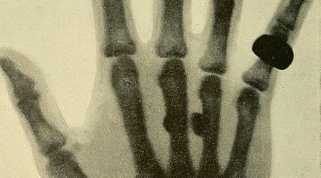 x ray